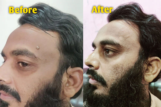 Best Wart Cure Cream in Pakistan | Herbal Tibb Wart Cure Instant Cream